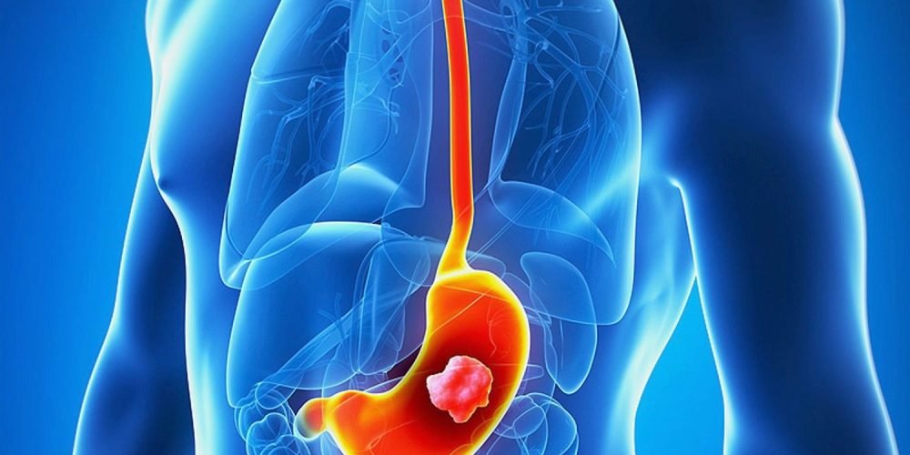 {Taj Medico} Stomach cancer symptoms, diagnosis and treatment