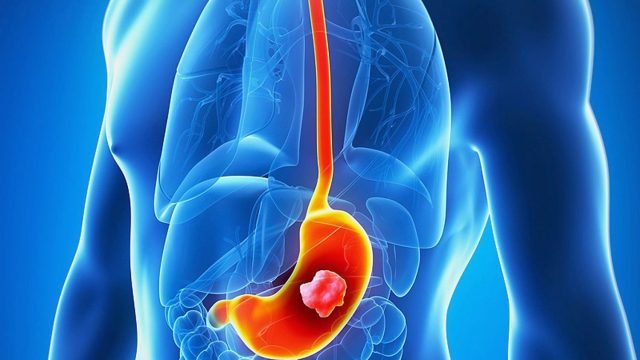 {Taj Medico} Stomach cancer symptoms, diagnosis and treatment